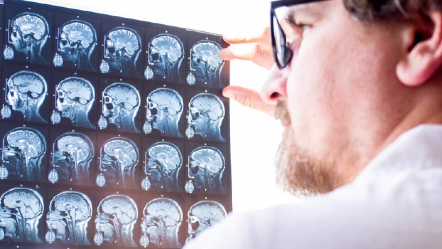 Pictured: Doctor looking at a patient's MRI brain scan