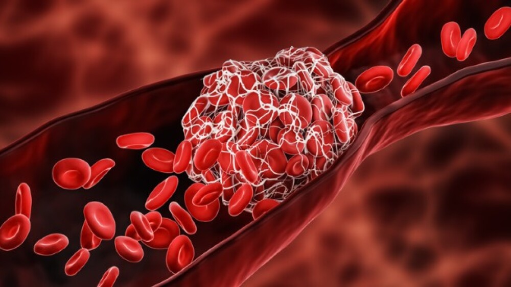 Pictured: Illustration of a blood clot in a blood