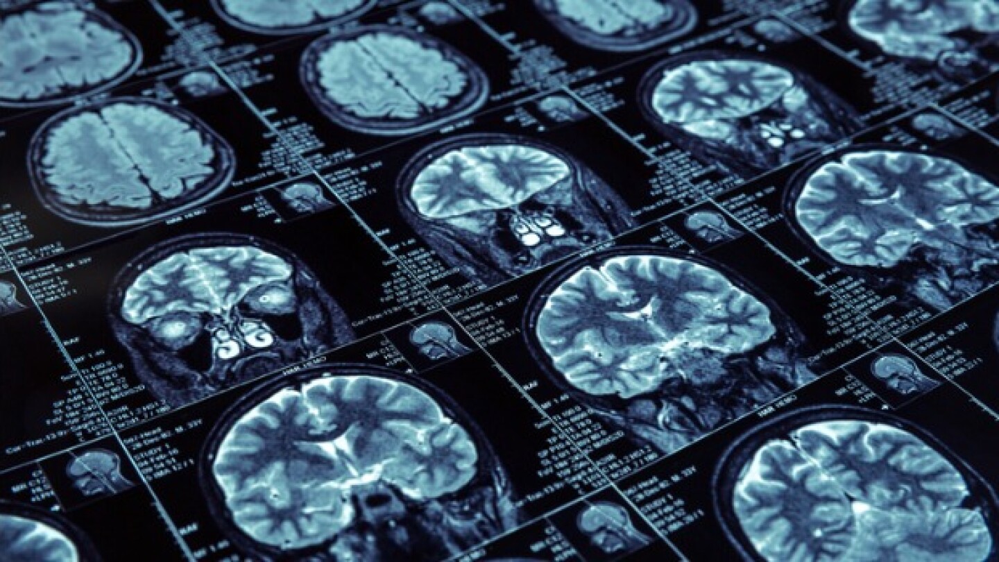 Pictured: MRI scans of the brain/iStock, Nomadsoul