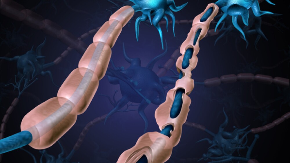 Multiple sclerosis damaged myelin or MS autoimmune disease with healthy nerve with exposed fibre with scarrred cell sheath loss as a 3D illustration.