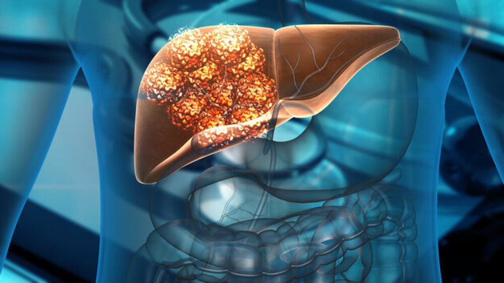 Pictured: Cancer cells growing on the liver/iStock