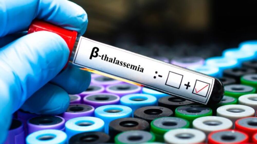 Pictured: A blood sample of a patient tested positive for beta-thalassemia