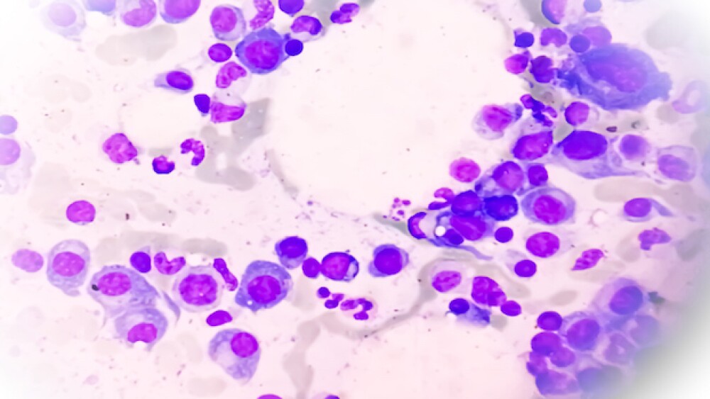 bone marrow slide showing multiple myeloma/iStock,