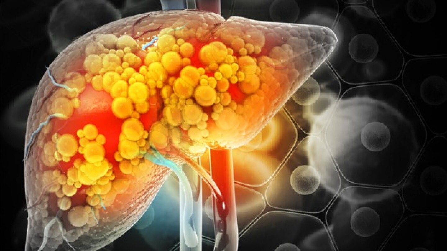 Pictured: 3D illustration of a damaged liver/iStoc