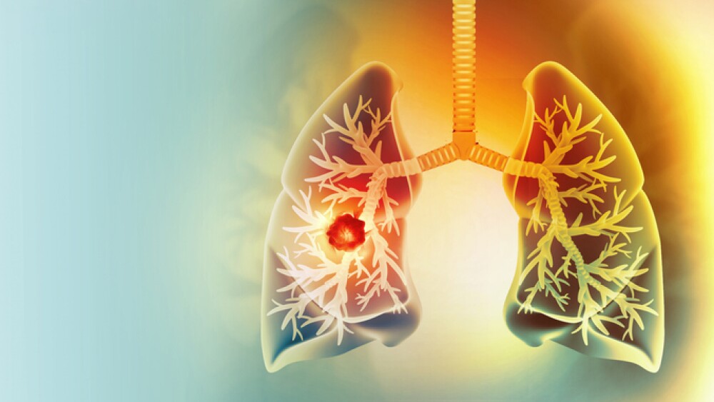 Medically accurate illustration of lung cancer. showing presence of cancerous tumor inside the lungs. 3d illustration