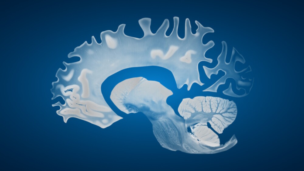 Sagittal brain showing cortical thinning and ventricular enlargement associated with Alzheimer disease, displayed on a blue background for anatomical clarity.