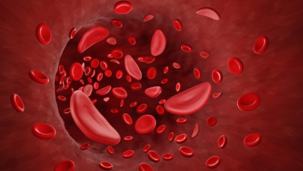 Pictured: Illustration showing sickle cells in the