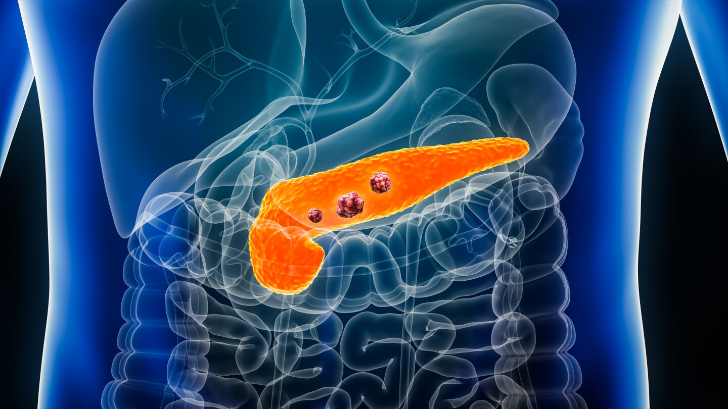 3D Illustration of a pancreas with tumors