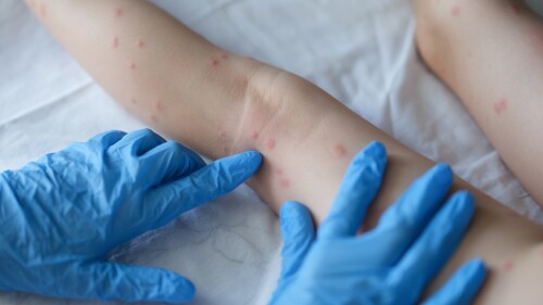 Doctor in rubber gloves examining rashes a child's legs