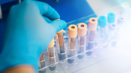 Rack with tubes blood samples from patients for analysis in the hematology lab .