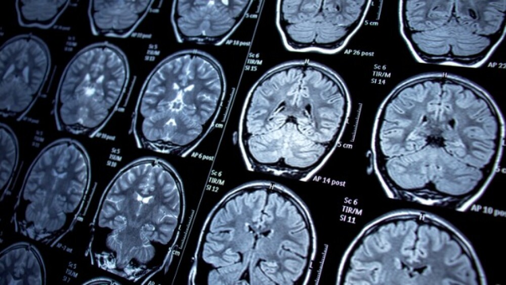 Pictured: Magnetic resonance imaging scans of the brain