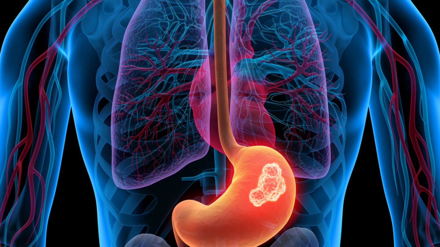 3D illustration of a stomach tumor