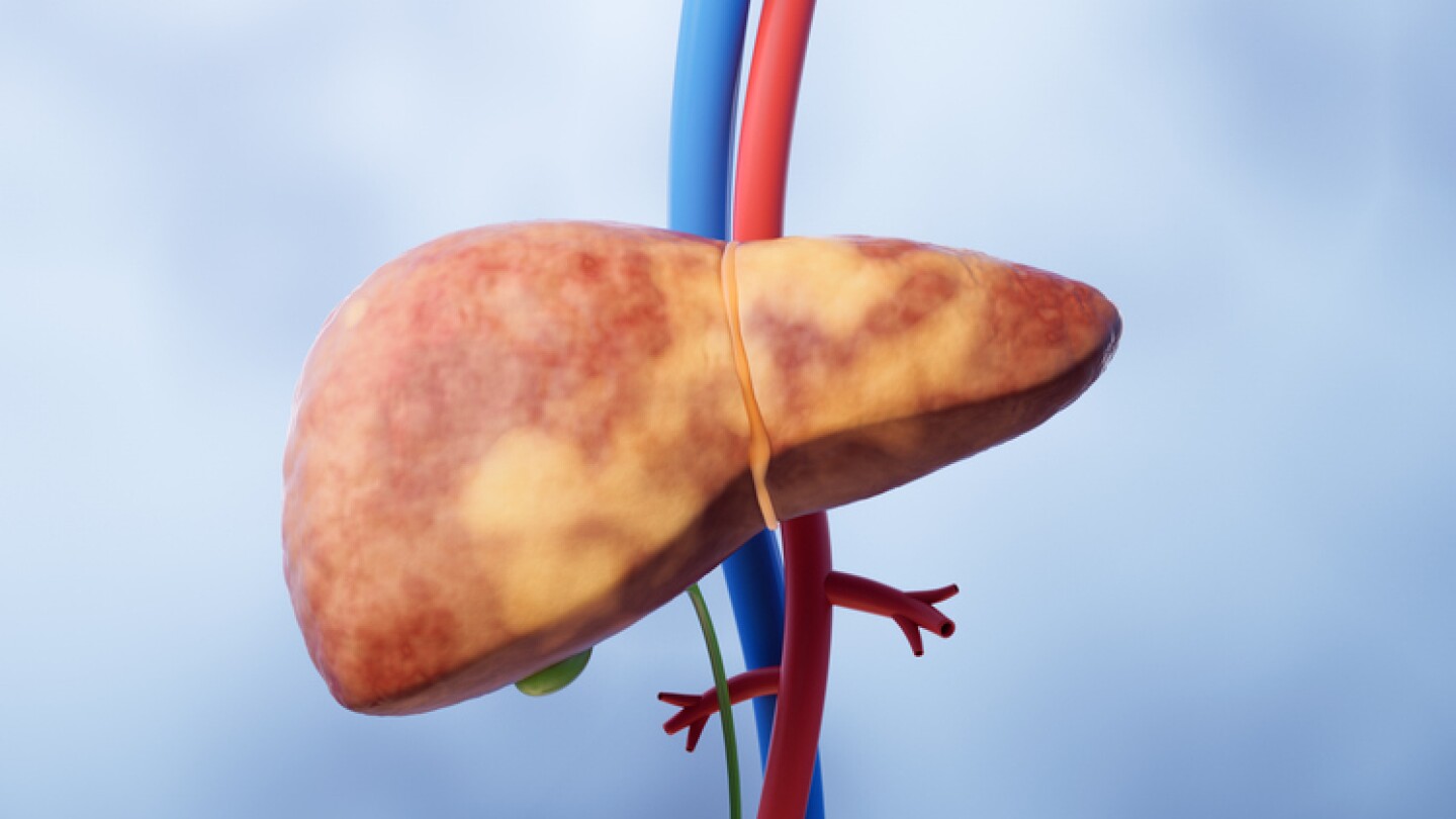 3D illustration of a fatty liver