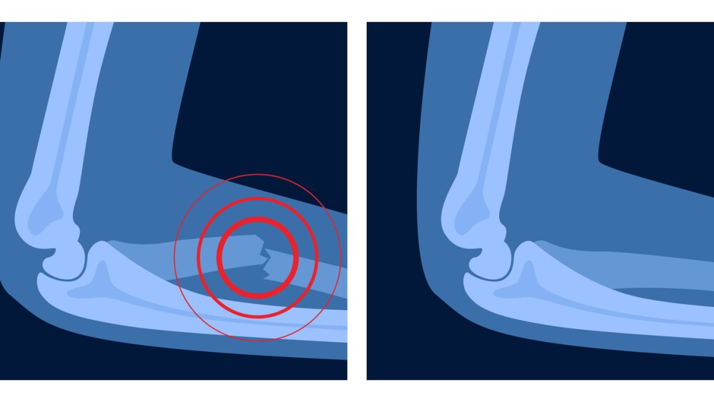 X ray of arm fracture with red pain point. Broken hand with open type of fracture. Human skeleton anatomy concept. Medical banner for clinic or hospital. Vector