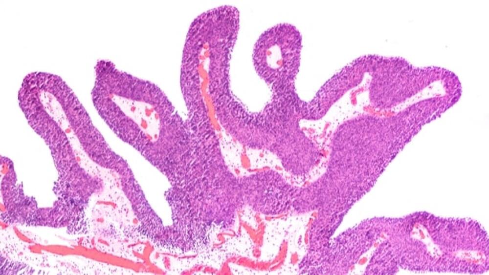 Sitravatinib is showing positive results.