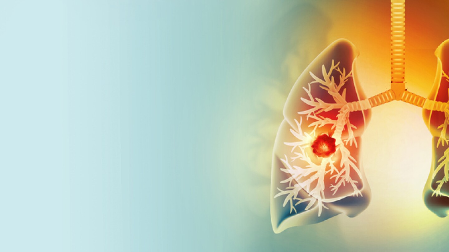 Medically accurate illustration of lung cancer. showing presence of cancerous tumor inside the lungs. 3d illustration
