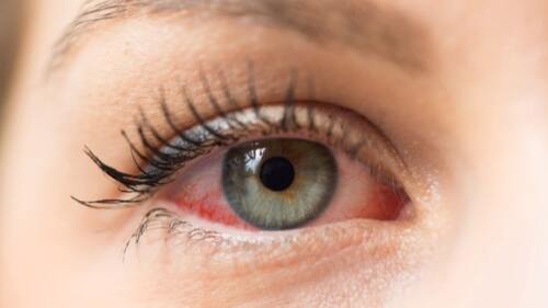 EYSUVIS become the first FDA approved treatment fo