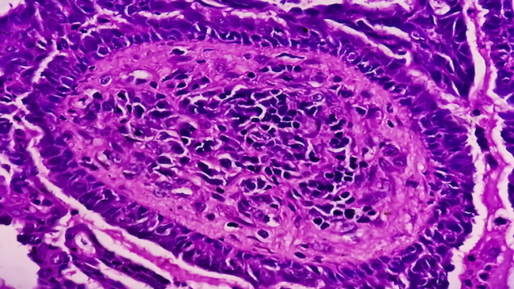 Pictured: micrograph of uterine biopsy/iStock