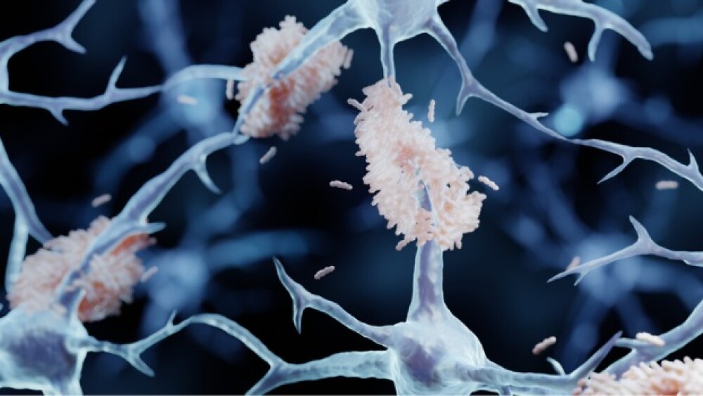 Pictured: Alzheimer's disease illustration/iStock,