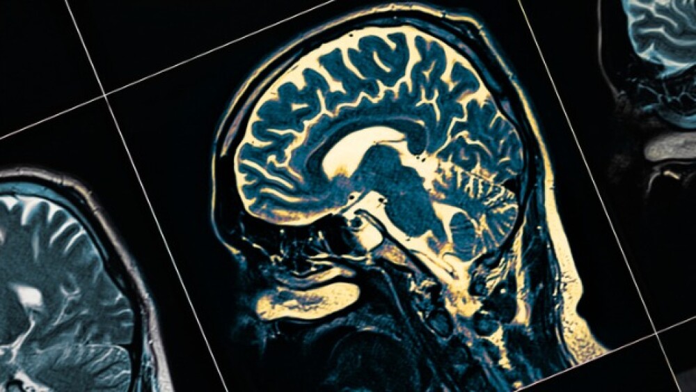 Pictured: Image of an MRI brain scan/iStock, sudok