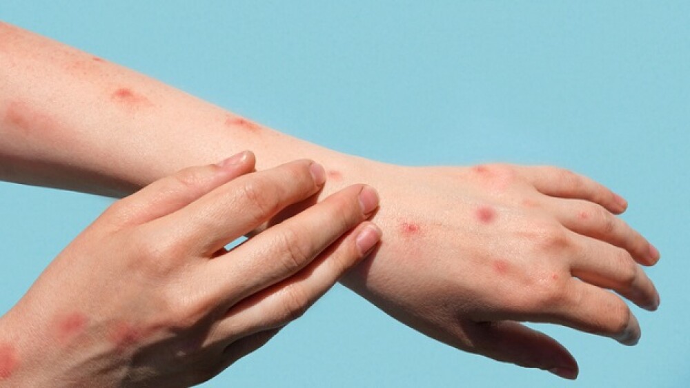 Monkeypox new disease dangerous over the world. Patient with Monkey Pox. Painful rash, red spots blisters on the hand. Close up rash, human hands with Health problem. Banner, copy space. Painful rash, red spots blisters on the hand. Close up Allergy rash, human hands with dermatitis and Health problem. Ill eczema skin of patient. Viral Diseases. Red rashes on the palm. Enterovirus. coxsackie