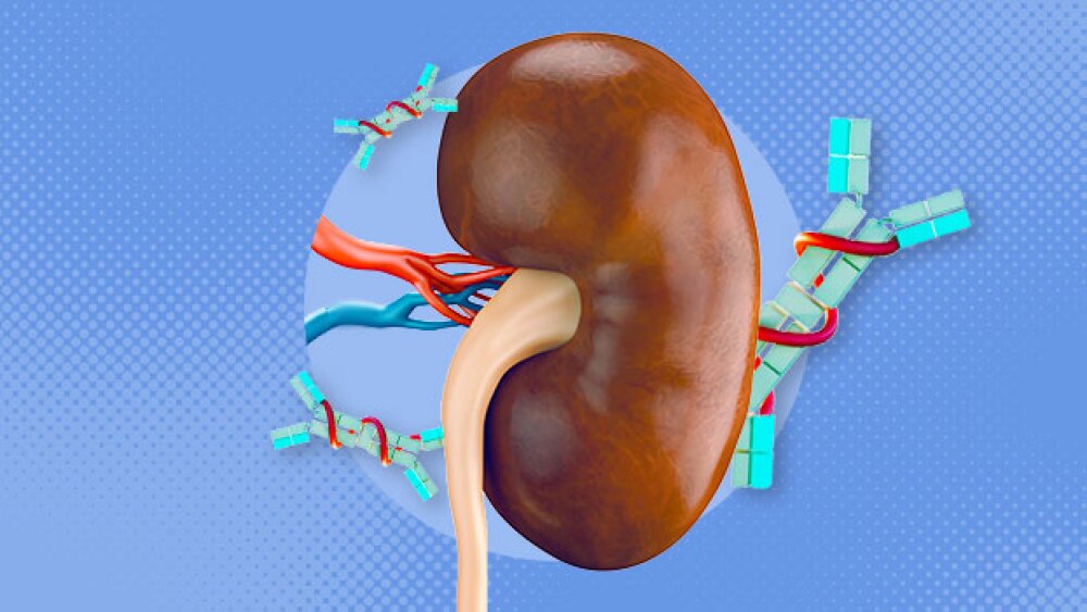 Pictured: A kidney with IgA antibodies/Taylor Tied