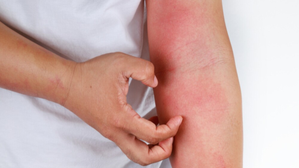 Pictured: Atopic dermatitis patient scratches thei