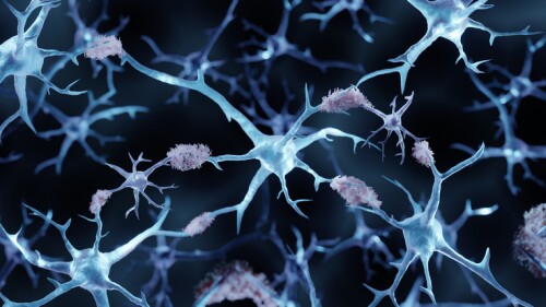 3d illustration showing amyloid plaques in Alzheimer's disease