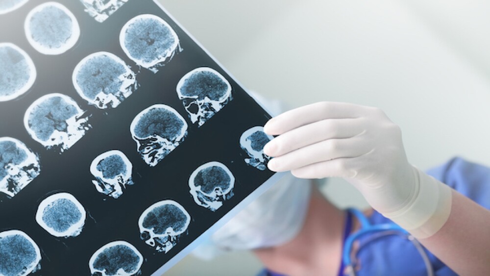 Pictured: A physician studies a brain scan/iStock,