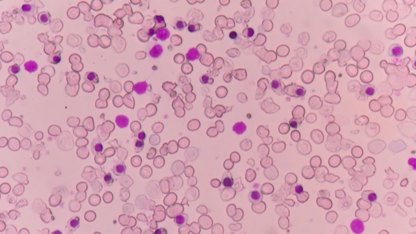 FDA Approves Celgene and Acceleron's Treatment for Rare Blood Disease ...