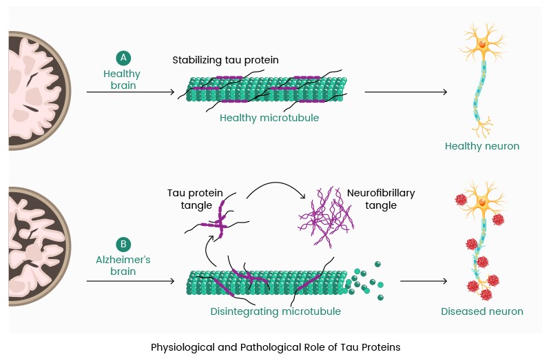Image of a healthy bran stabilizing a tau protein, versus a brain with Alzheimer's and a disintegrating microtubule