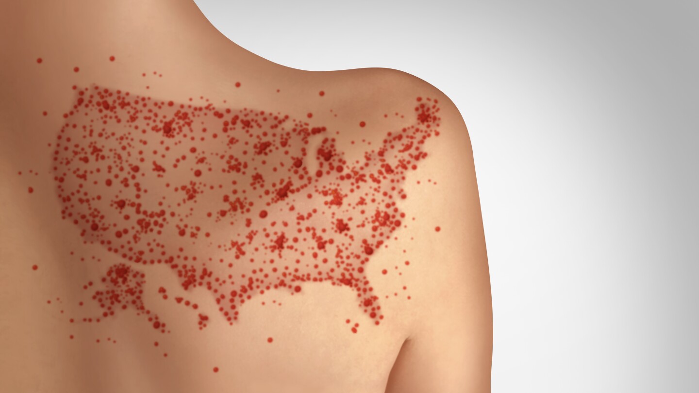 US Measles Outbreak and Increase in infection cases concept as a rising deadly outbreak disease and viral illness as a contagious chickenpox or a skin rash.