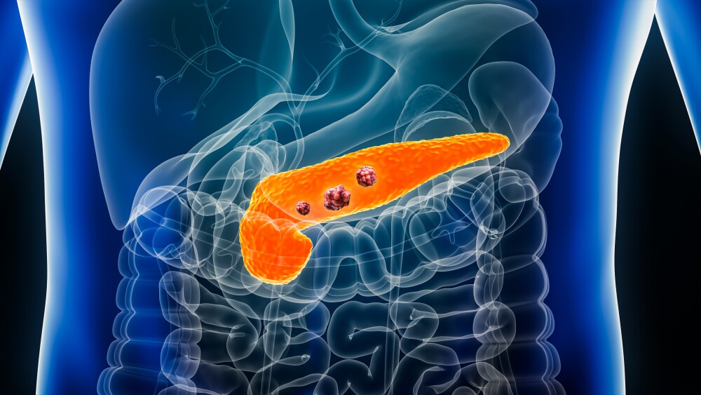 3D Illustration of a pancreas with tumors