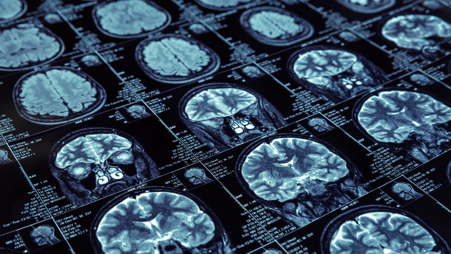 MRI scans of a human brain