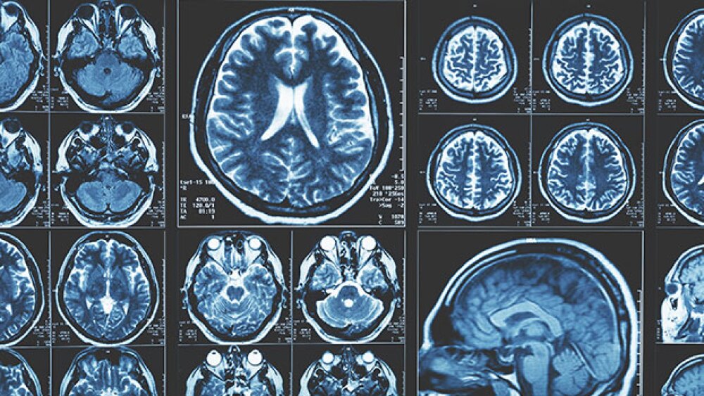 Pictured: A MRI brain scan background, magnetic us