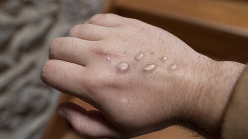 Monkey pox vesicles in a hand