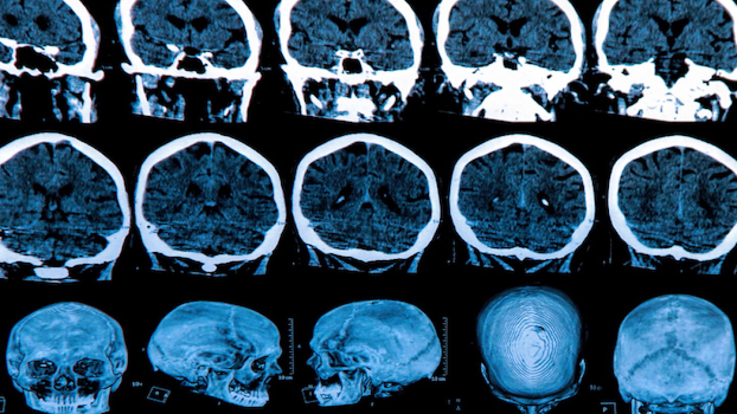 glp-1 drugs and alzheimer's Coveted GLP-1 Drugs Show Early Promise in Alzheimer's Disease glp-1 drugs and alzheimer's Coveted GLP-1 Drugs Show Early Promise in Alzheimer's Disease