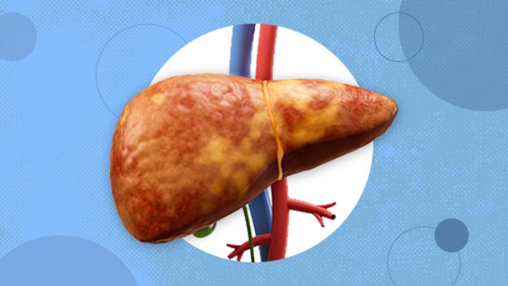 Pictured: A collage containing a fatty liver over blood vessels