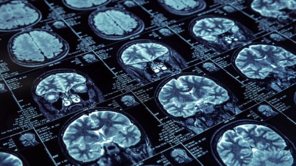 Pictured: MRI scans of the brain/iStock, Nomadsoul