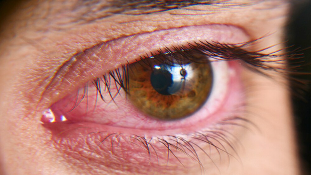 Pictured: A dry eye/Kryuchka Yaroslav_Adobe Stock