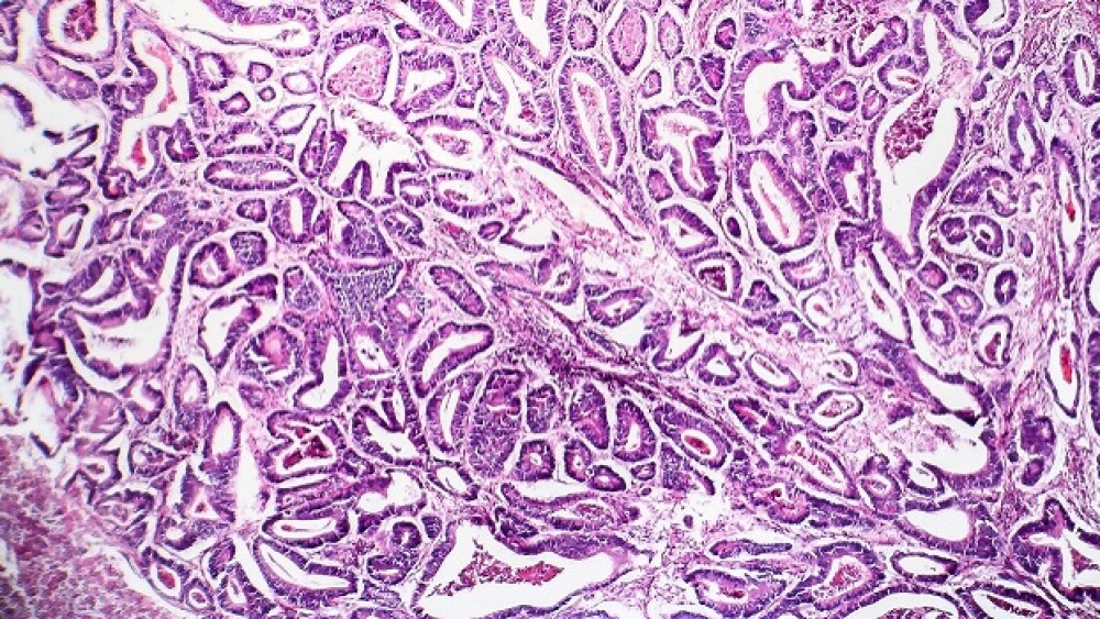 Colon cancer, light micrograph, photo under microscope