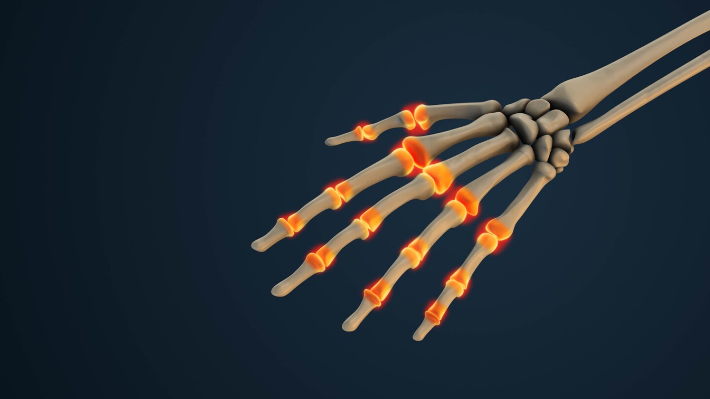 Rheumatoid arthritis (RA) commonly causes inflammation in the hands, leading to pain, swelling, and stiffness in the joints, particularly the small joints of the fingers and wrists. This inflammation results from the immune system attacking the body's own joint tissues, causing the synovium (lining of the joint) to become inflamed and release chemicals that damage nearby tissues.