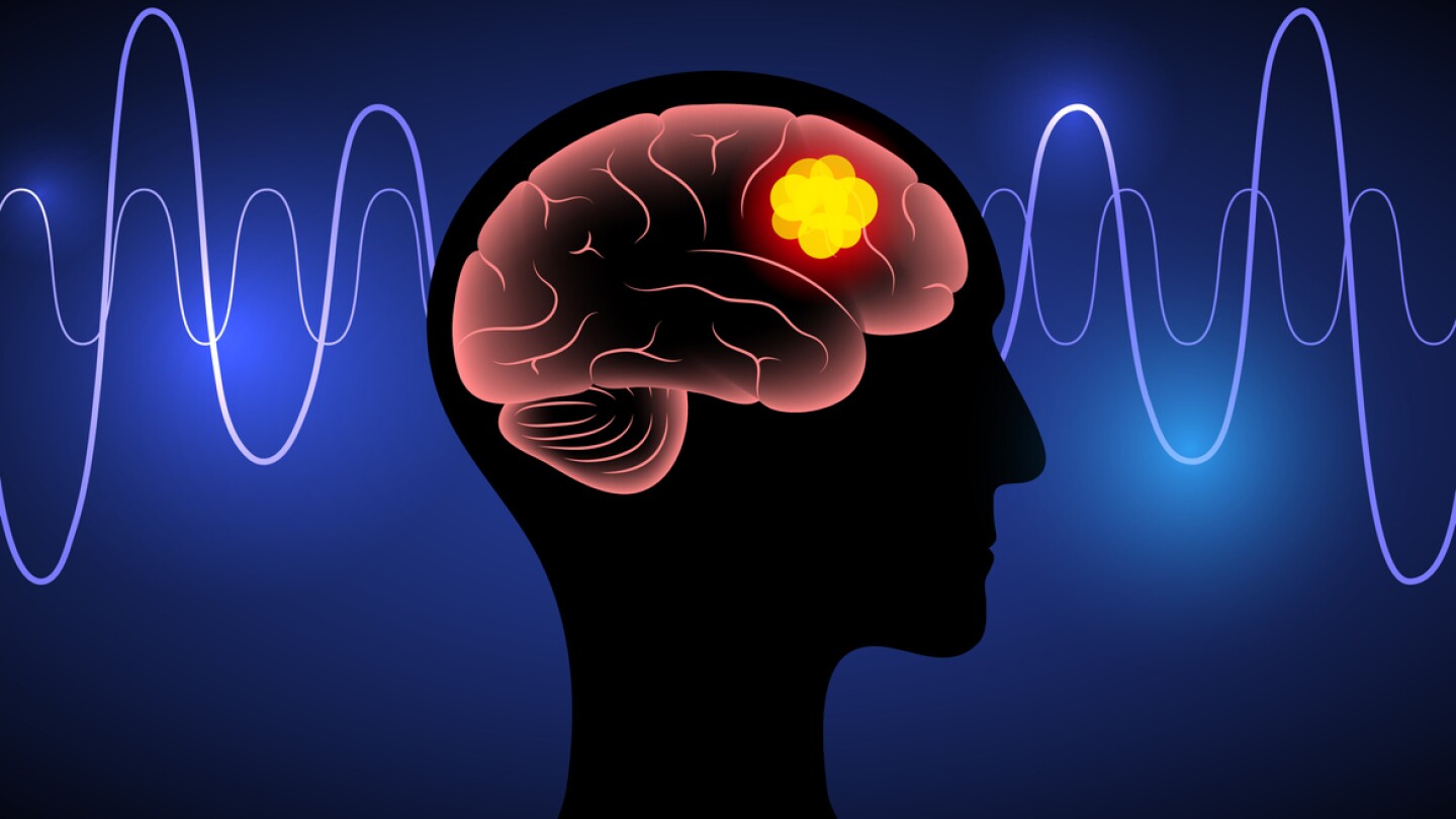 Brain tumor medical poster. Cancer, metastasis or benign in the human head or in the nerves, pituitary gland, pineal gland, and membranes that cover the surface of the brain 3D vector illustration