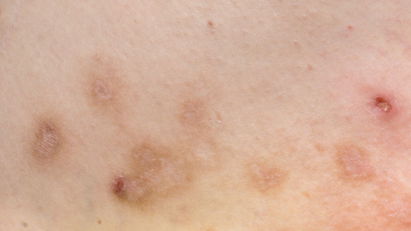 Skin lesions of prurigo nodularis, including