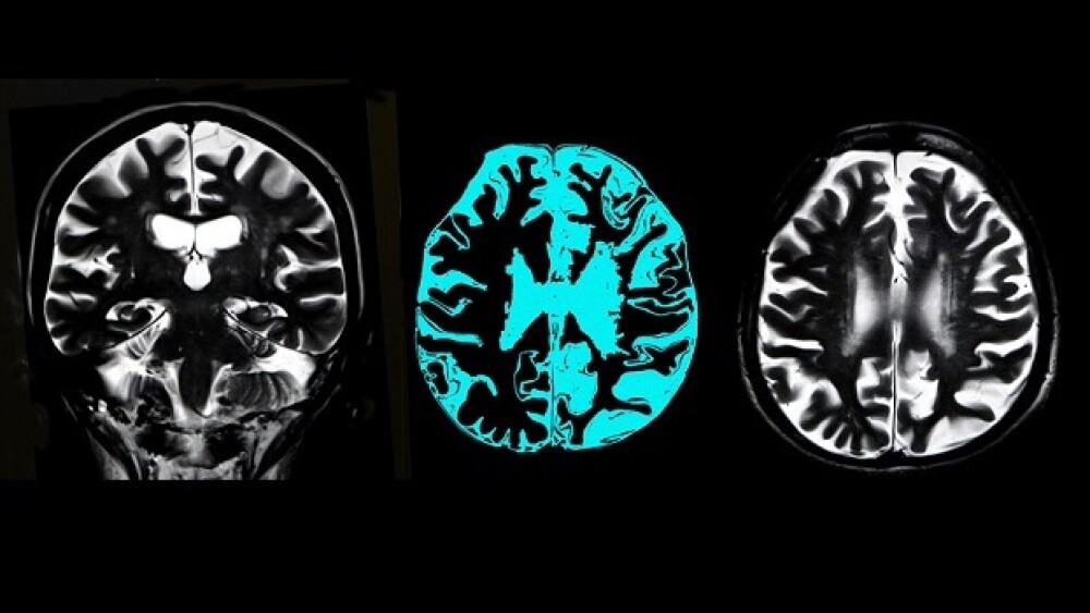 Pictured: Three side-by-side scans of a human brai