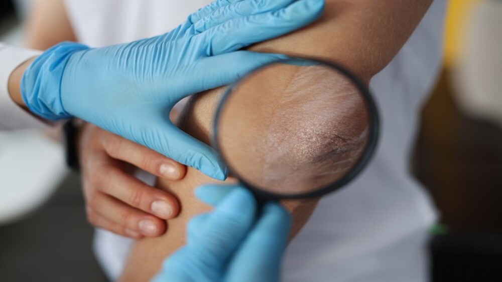Doctor examines patient scaly elbow through magnifying glass. Skin diseases and allergies concept