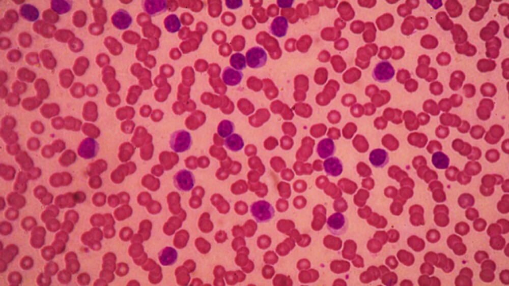 Chronic lymphocytic leukemia