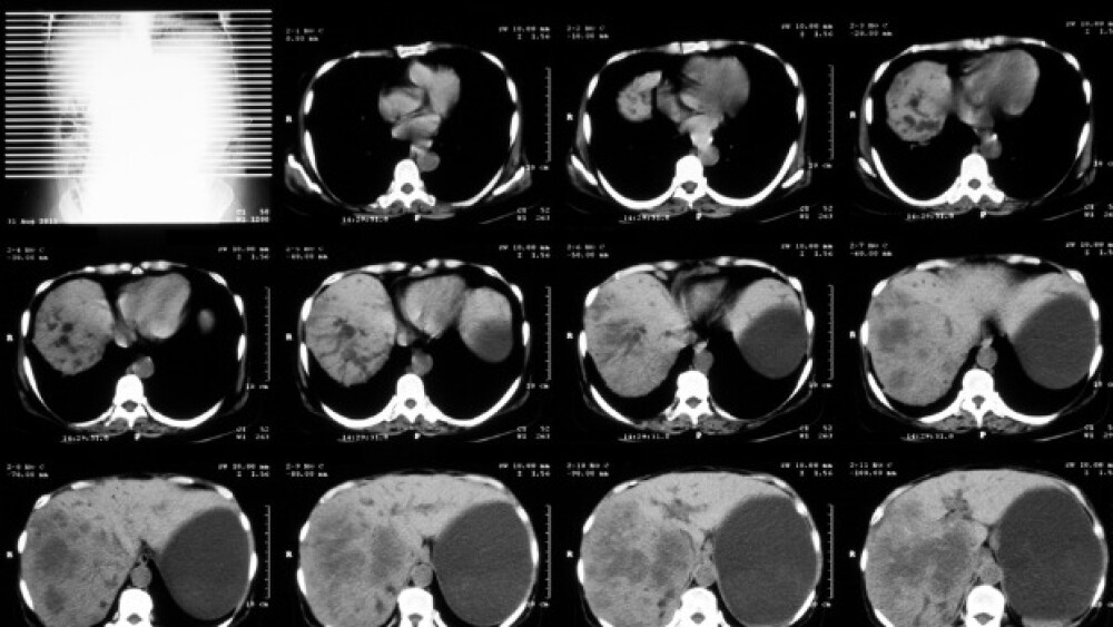Pictured: Cat scan of abdomen/Sutthaburawonk/iStoc