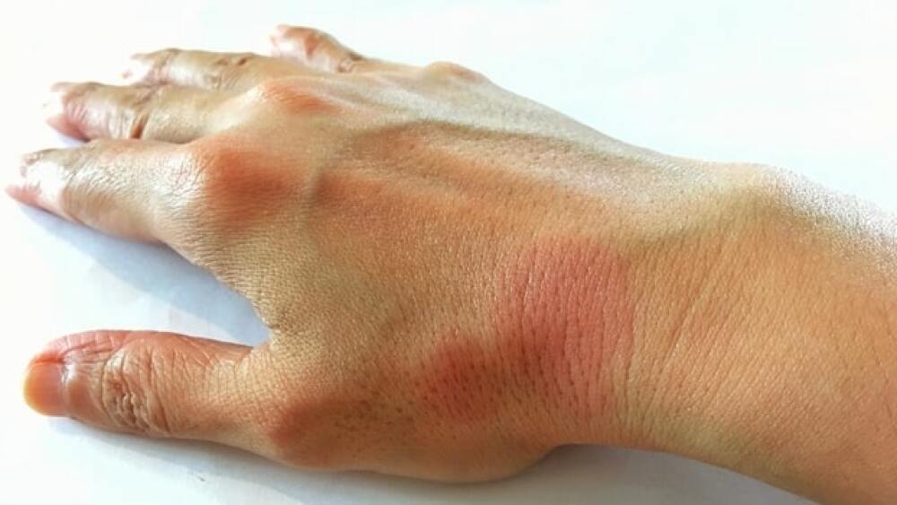 Lupus drug candidate BIIB059 showing promising res