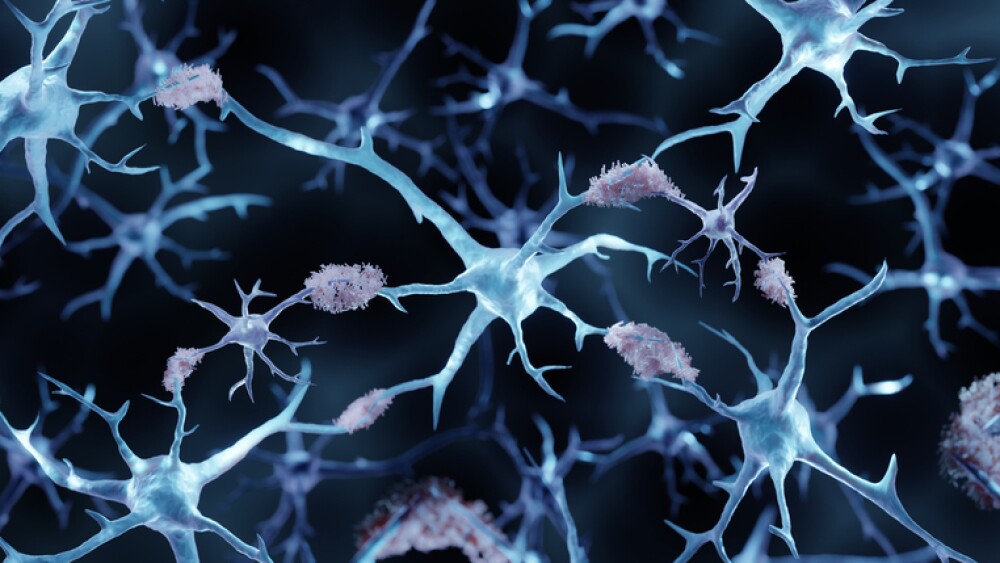 3d illustration showing amyloid plaques in Alzheimer's disease